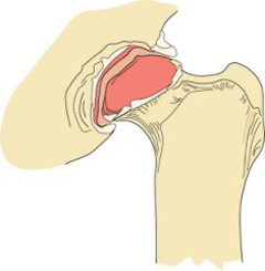 Figure 2. The result of the joint instability is abnormal wear of the cartilage. Cartilage wear leads to the formation of bone spurs and scar tissue, which are the characteristic signs of hip arthritis.