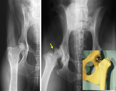 Figure 6. Normal hip (left) and arthritic hip (arrow). Total Hip Replacement can restore normal structure and function of “ball and socket” joint with implants (color picture).