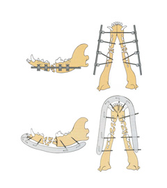 Figure 5. Use of an ESF for multiple piece mandibular fractures. The top illustrations utilized linear ESF while the bottom illustrations show the use of pins with acrylic connecting material. From Fossum TW, et al: Small Animal Surgery, 3rd edition. ©2007